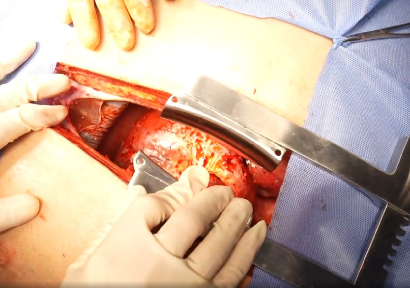 胸腹部損傷控制手術(shù)模擬人系統3.0